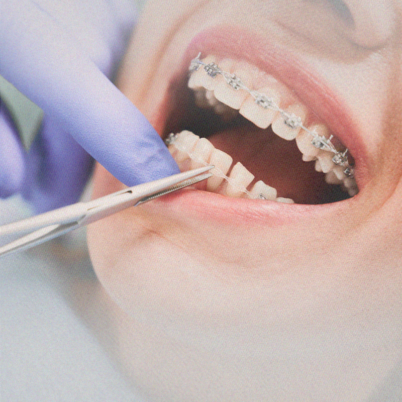 Ortodontia Preventiva: como identificar problemas precocemente e prevenir a necessidade de tratamentos mais invasivos