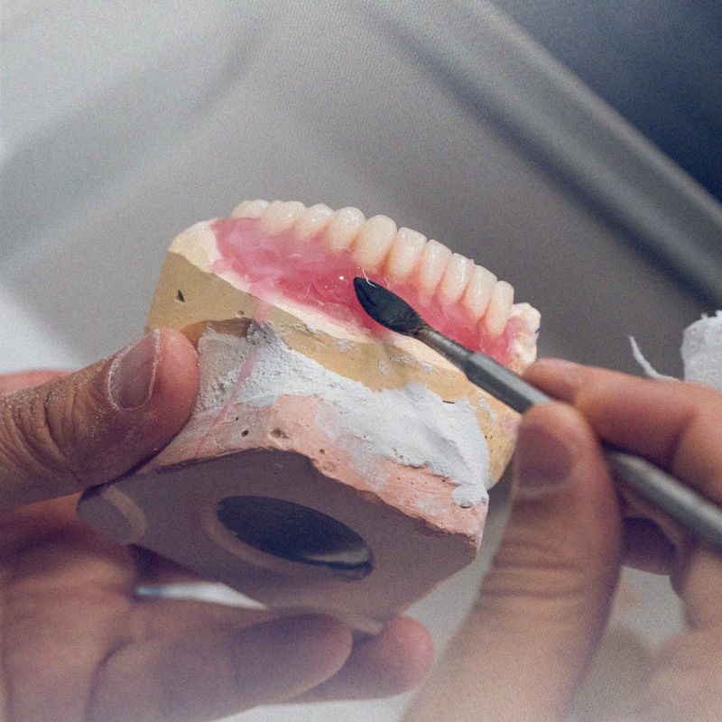 Tudo sobre implantes dentários